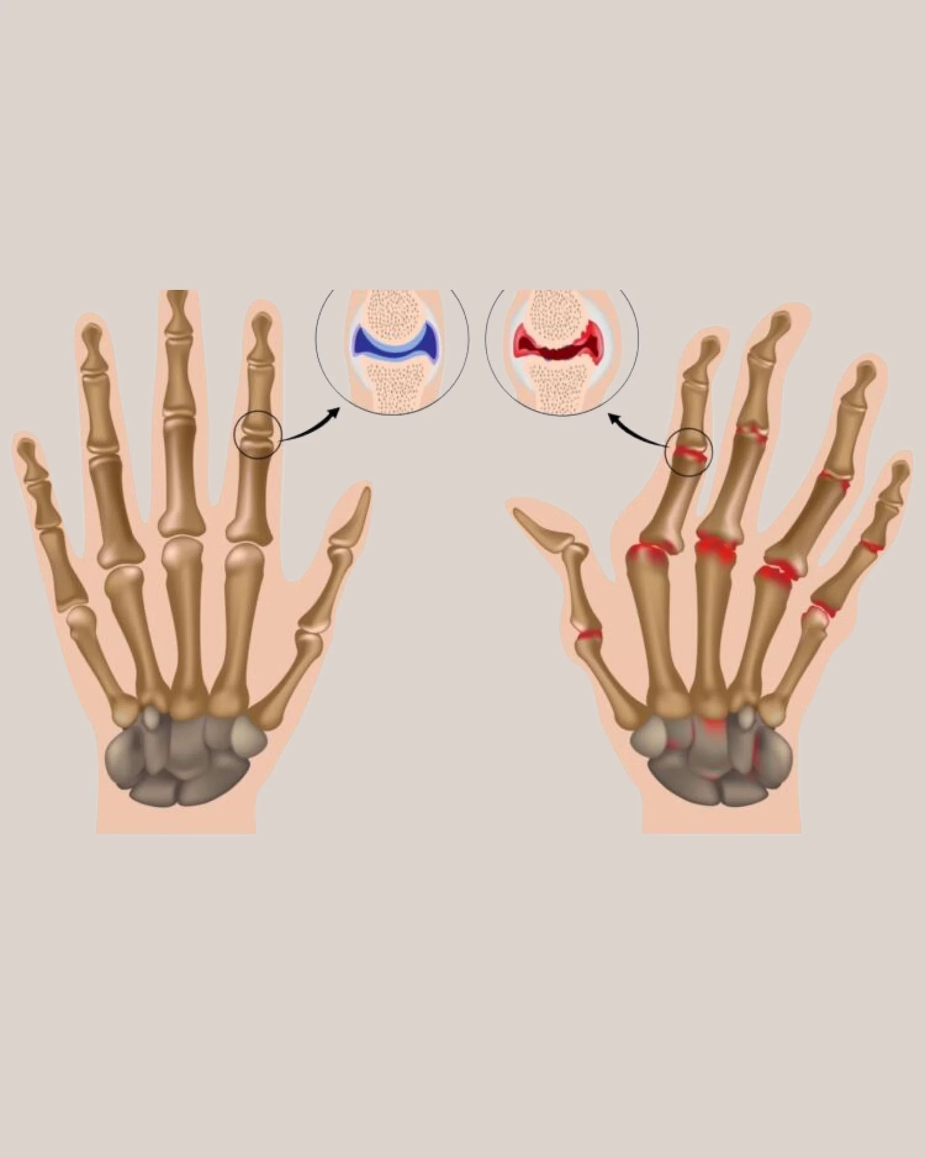 Dr Divya Bandari -  Arthritis Treatment Specialist